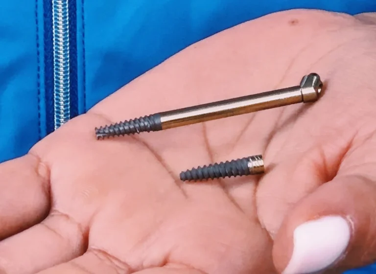 COPERTINA BLOG 1 Cosa è un impianto dentale