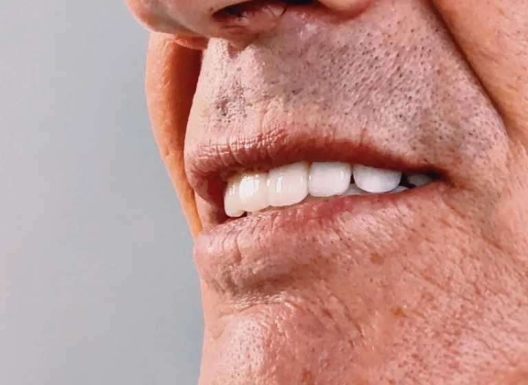 COPERTINA BLOG 16 Faccette dentali e forma dei denti
