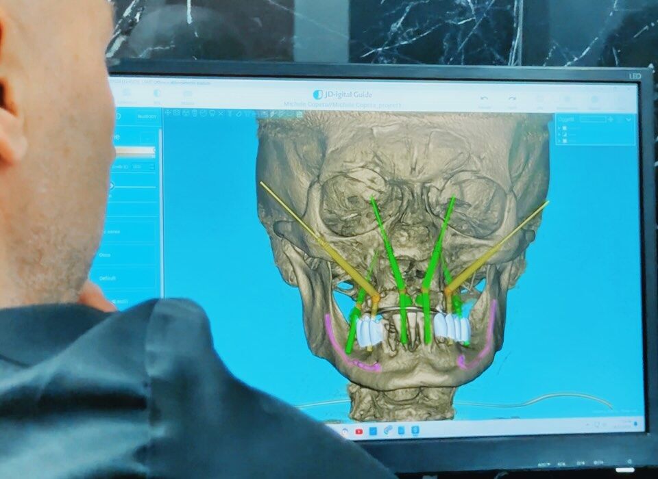 impianti dentali zigomatici nei casi complessi